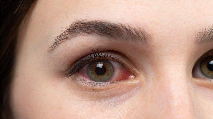 cegah-retinopati-diabetika-pasien-dengan-diabetes-disarankan-rutin-skrining-mata_8d9f86d.jpg