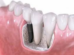 dental-implant-solusi-modern-atasi-untuk-mengatasi-kehilangan-gigi_9b17898.jpg