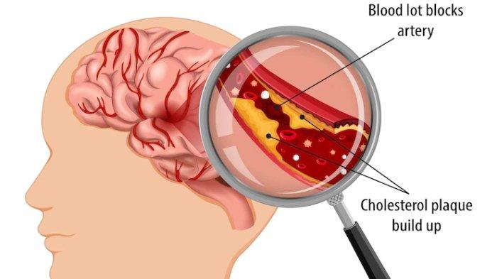 perkecil-risiko-kerusakan-otak-dengan-cepat-tanggap-segera-ke-rumah-sakit-saat-periode-emas-stroke_58a3875.jpg