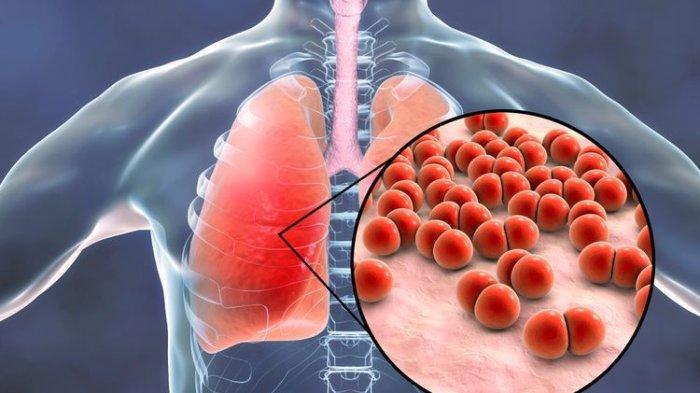 dokter-bagikan-cara-cegah-kematian-karena-pneumonia-_e767741.jpg