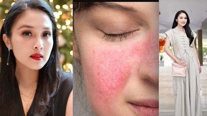 kenali-rosacea-penyakit-yang-picu-wajah-mulus-sandra-dewi-bernanah-harus-ganti-endorse-tas-mewah_b9c4a3a.jpg