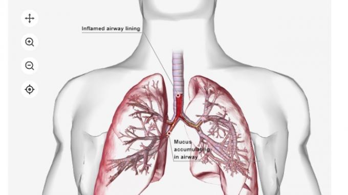 pneumonia-bisa-tingkatkan-risiko-terjadinya-serangan-jantung-berikut-penjelasan-dokter_3bd5217.jpg