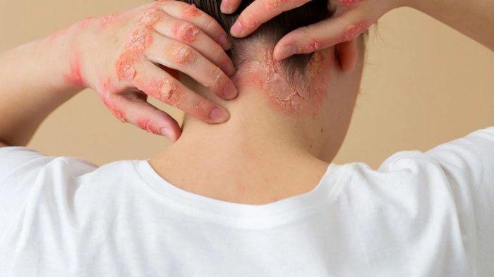 risiko-mandi-terlalu-lama-bagi-penderita-psoriasis-menurut-penjelasan-dokter-spesialis-kulit_8504565.jpg