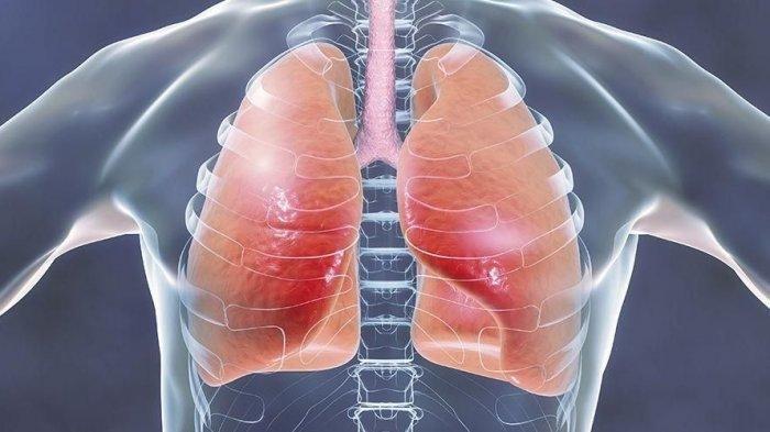 perokok-hingga-penderita-penyakit-metabolik-rentan-alami-fibrosis-pada-paru-paru_8dfa944.jpg